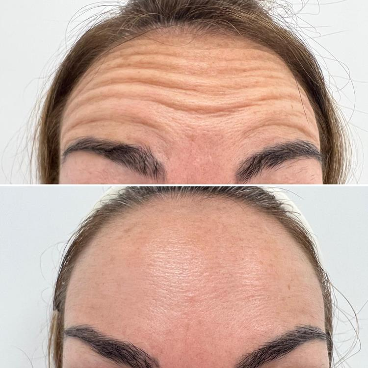 Caso de botox com antes e depois na mesma imagem