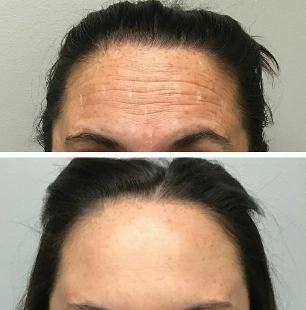 Outro caso de botox com antes e depois na mesma imagem