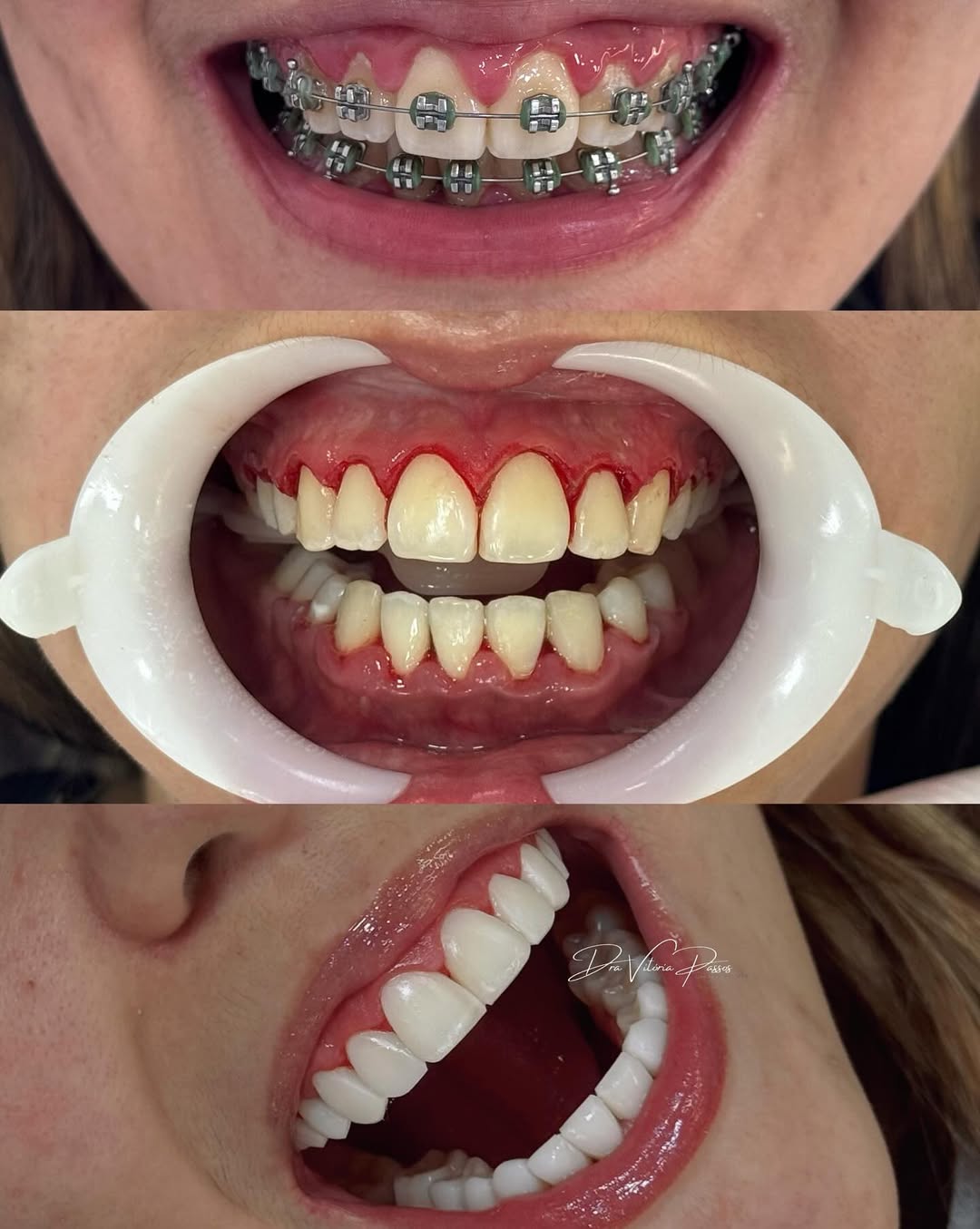 Caso de gengivoplastia com antes, procedimento e resultado