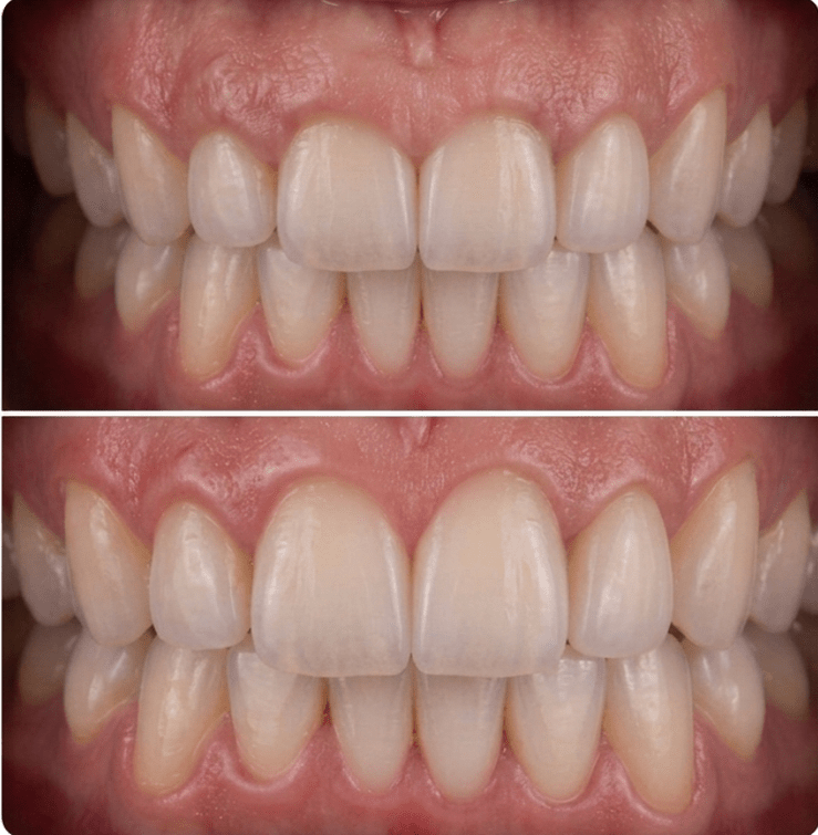 Antes e depois de gengivoplastia