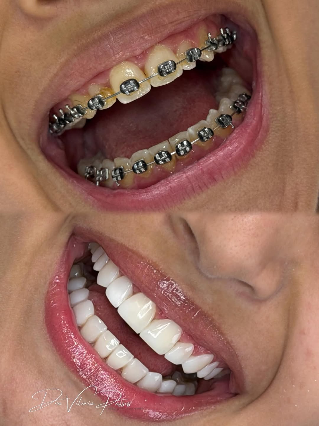 Caso de lentes em resina com antes e depois na mesma imagem