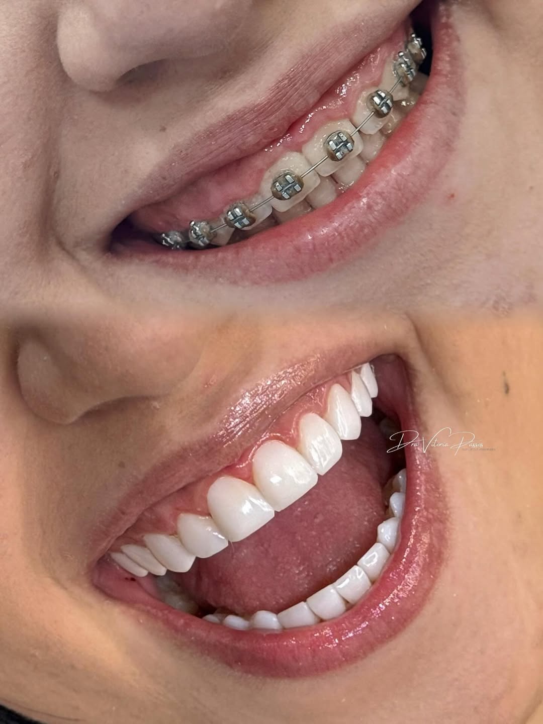 Outro caso de lentes em resina com antes e depois na mesma imagem