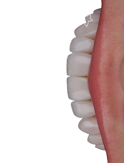 Detalhes de transformação com lentes dentárias