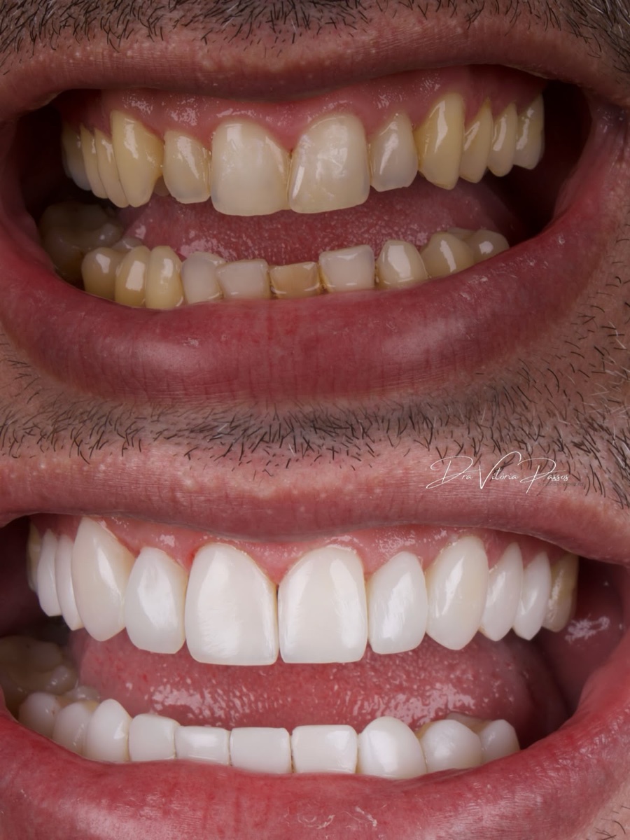 Caso de lentes premium com antes e depois na mesma imagem