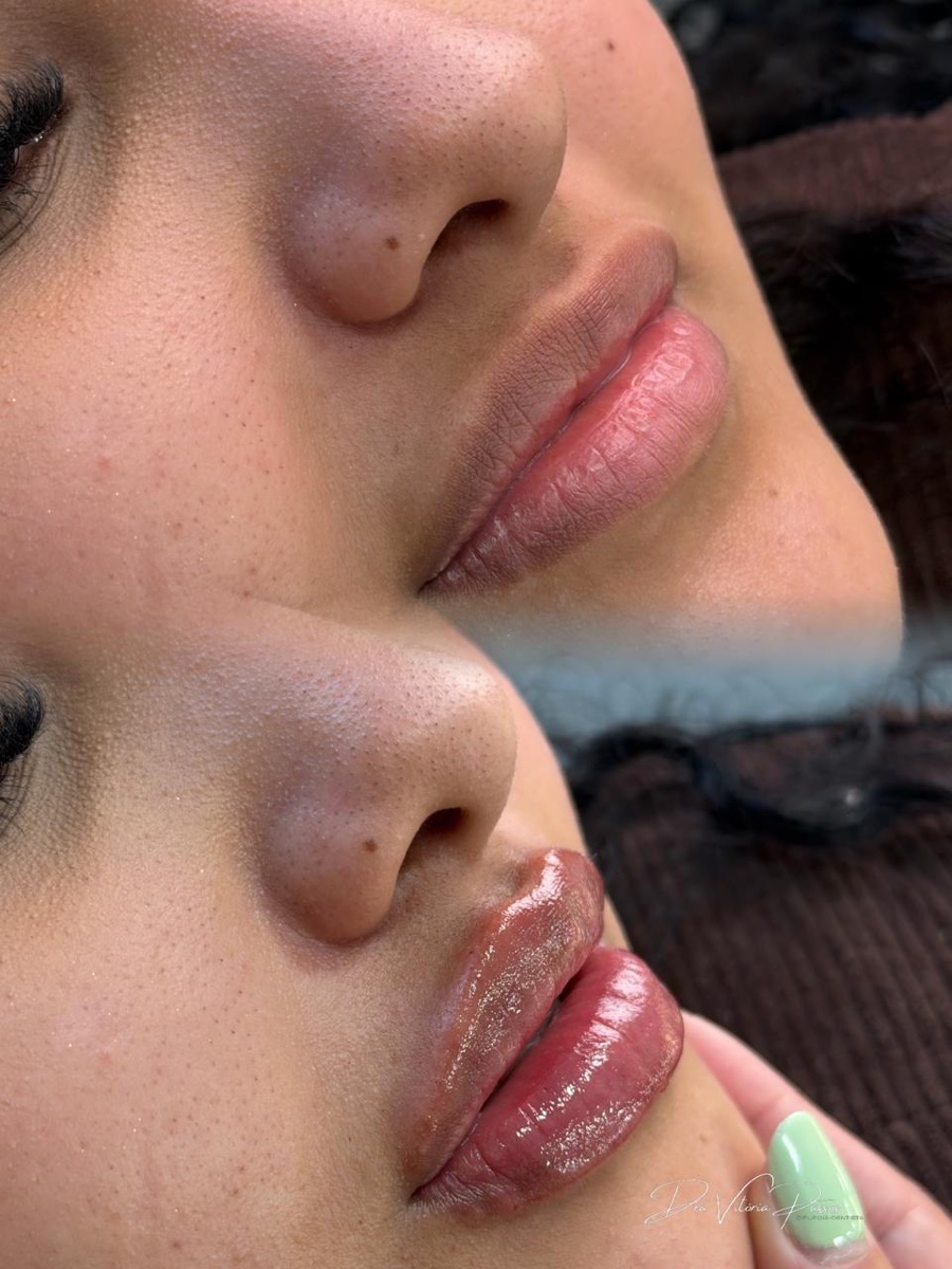 Caso de preenchimento labial com antes e depois na mesma imagem